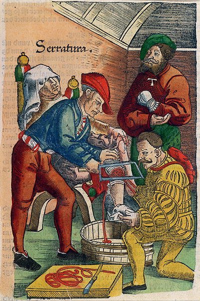 An Amputation, illustration from Feldtbuch der Wundartzney by Hans von Gersdorff, c.1540