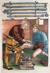 Cauterisation, illustration from Feldtbuch der Wundartzney by Hans von Gersdorff, c.1540